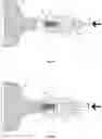 Fig. 14 - Method and device for interventricular septal ablation