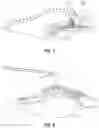 Fig. 07 - Modeling a collapsed lung using CT data