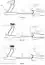 Fig. 05 - Intraoperative adjustment of a pre-operatively planned implant cavity to improve implant fit