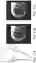 Fig. 16 - System and method for image localization of effecters during a medical procedure