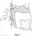 Fig. 09 - Orthodontic bracket for use on deciduous teeth