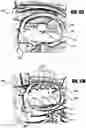 Fig. 10 - Teeth whitening apparatus