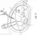 Fig. 12 - SHAPE MEMORY PATCH FOR TISSUE REPAIR