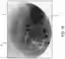 Fig. 17 - SHAPE MEMORY PATCH FOR TISSUE REPAIR