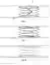 Fig. 04 - Vascular filter device