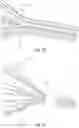 Fig. 16 - Vascular filter device