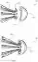 Fig. 50 - Vascular filter device