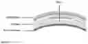 Fig. 32 - Devices and methods for novel retinal irradiance distribution modification to improve and restore vision without producing corneal vitrification