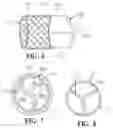Fig. 04 - Mitral valve prosthesis