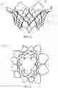 Fig. 08 - Apparatus and methods for anterior valve leaflet management