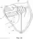 Fig. 30 - Apparatus and methods for anterior valve leaflet management