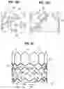 Fig. 07 - Prosthetic heart valve