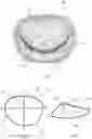 Fig. 02 - Method for generating a mitral repair ring, and mitral repair ring