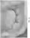 Fig. 05 - Device, system, and method for transcatheter treatment of valvular regurgitation