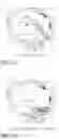 Fig. 28 - Device, system, and method for transcatheter treatment of valvular regurgitation