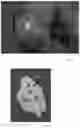 Fig. 02 - PATIENT SPECIFIC CARTILAGE DEFECT REPLACEMENT