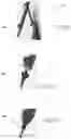 Fig. 06 - SYSTEM AND METHOD FOR PRODUCING A CRANIAL OPERCULUM FOR A LIVING BEING
