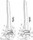 Fig. 13 - Trial radial head implant