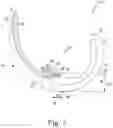 Fig. 04 - Total knee implant prosthesis assembly and method