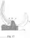 Fig. 12 - Total knee implant prosthesis assembly and method