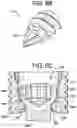 Fig. 08 - Baseplate of a modular shoulder joint prosthesis and related methods for implanting the same