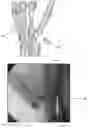 Fig. 03 - Patient specific carpal implant