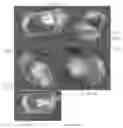Fig. 07 - Patient specific carpal implant
