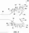 Fig. 04 - Biliary stent