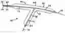 Fig. 01 - Stent system deployment method for bifurcated lesion