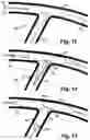 Fig. 06 - Stent system deployment method for bifurcated lesion