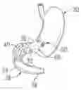 Fig. 01 - METHODS AND APPARATUS FOR ANCHORING A GASTROINTESTINAL IMPLANT