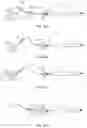 Fig. 10 - METHODS AND APPARATUS FOR ANCHORING A GASTROINTESTINAL IMPLANT