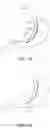 Fig. 02 - Endoluminal sleeve gastroplasty