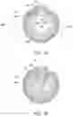 Fig. 09 - Endoluminal sleeve gastroplasty