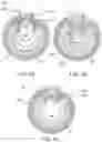 Fig. 10 - Endoluminal sleeve gastroplasty