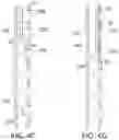 Fig. 12 - Endoluminal sleeve gastroplasty
