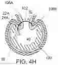 Fig. 13 - Endoluminal sleeve gastroplasty