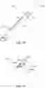 Fig. 17 - Endoluminal sleeve gastroplasty