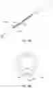 Fig. 19 - Endoluminal sleeve gastroplasty