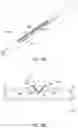 Fig. 20 - Endoluminal sleeve gastroplasty