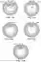 Fig. 22 - Endoluminal sleeve gastroplasty
