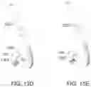 Fig. 30 - Endoluminal sleeve gastroplasty