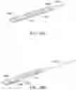 Fig. 35 - Endoluminal sleeve gastroplasty