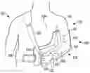 Fig. 01 - Orthopedic shoulder device