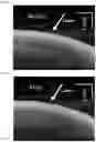 Fig. 14 - Laser thermal conjunctivoplasty