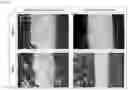 Fig. 18 - Laser thermal conjunctivoplasty