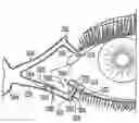 Fig. 01 - Lacrimal implants and related methods
