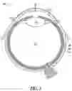 Fig. 02 - Lacrimal implants and related methods
