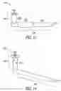 Fig. 11 - Lacrimal implants and related methods