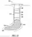 Fig. 22 - Lacrimal implants and related methods